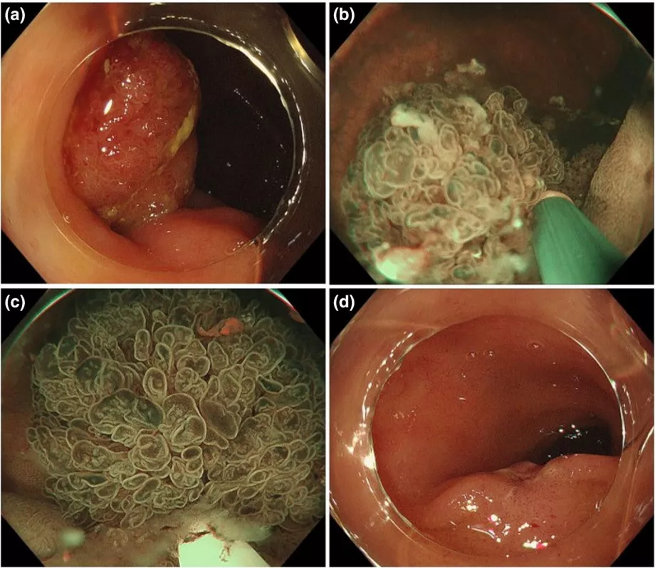 Underwater endoscopic mucosal