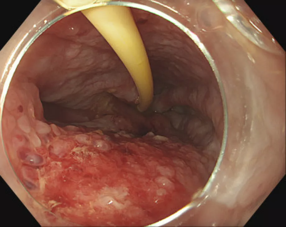 Successful endoscopic management