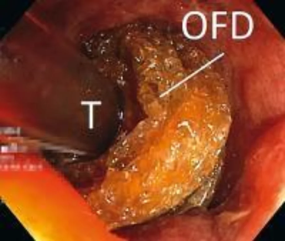 Den february endoscopy