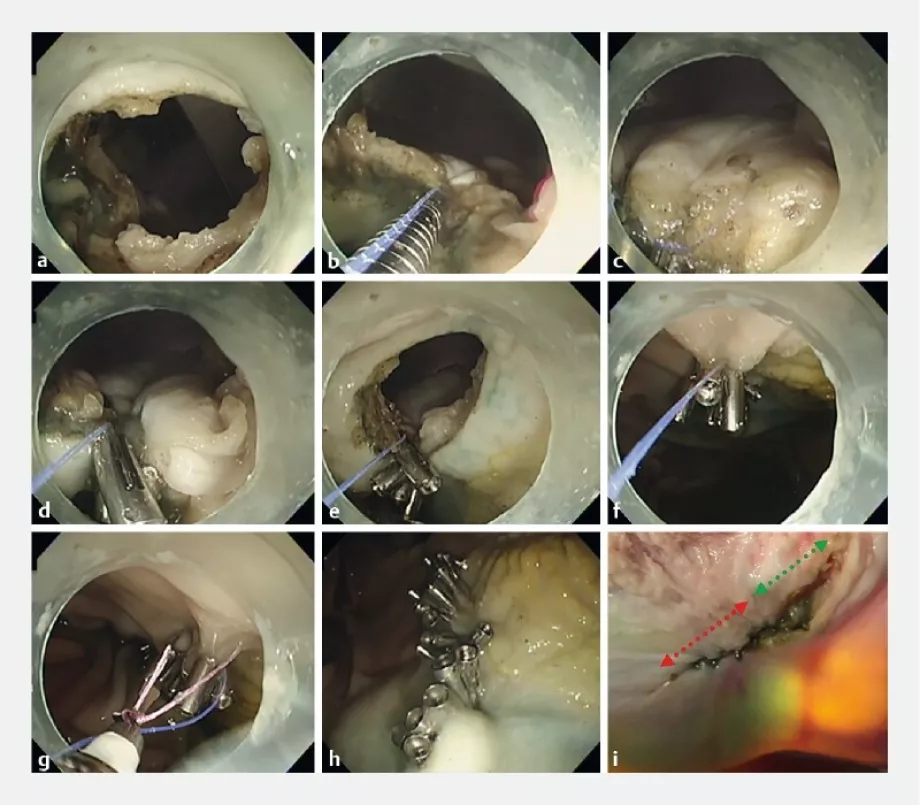 Den endoscopy presentation