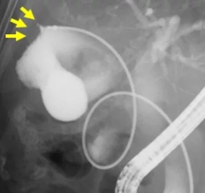 August video digestive endoscopy