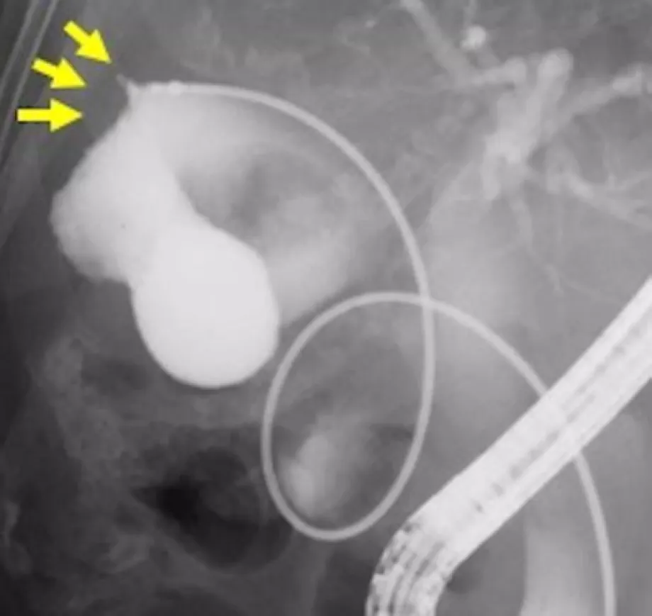 August video digestive endoscopy