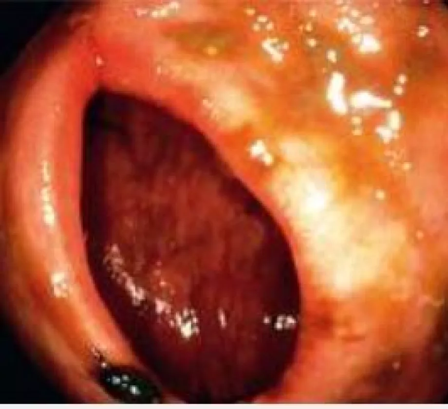 August video endoscopy