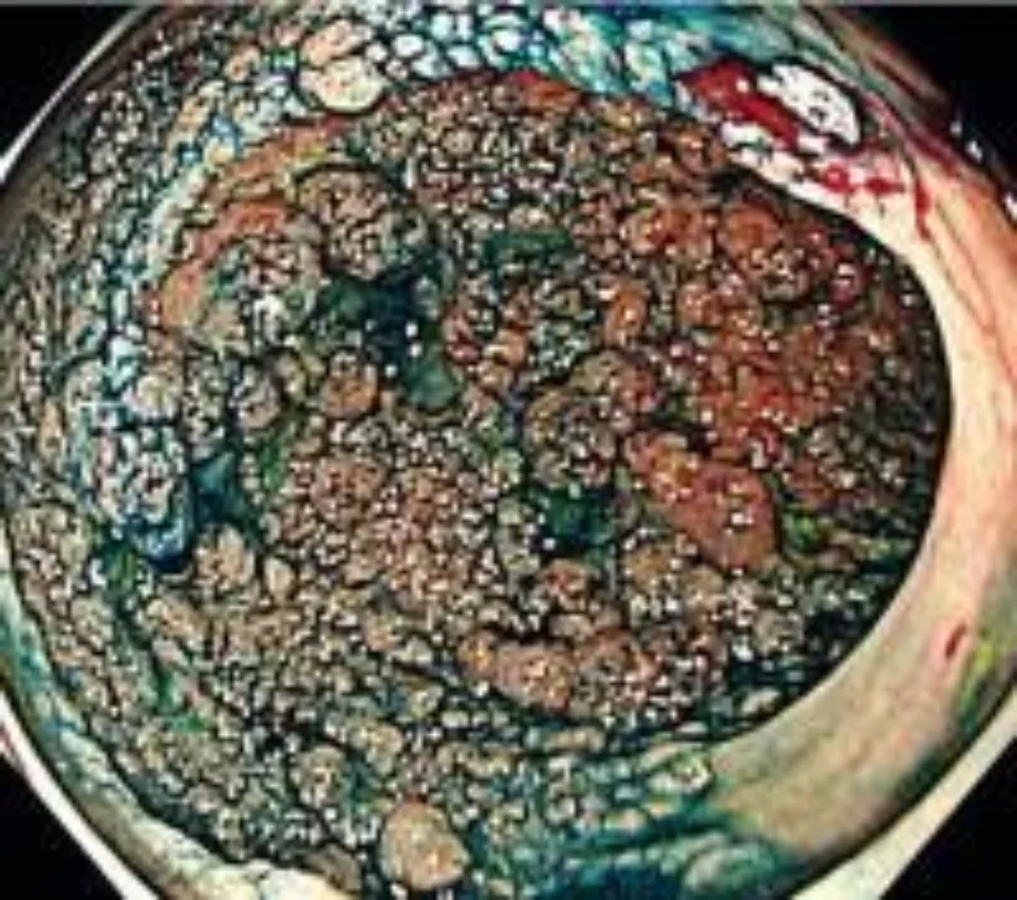 Den december endoscopy