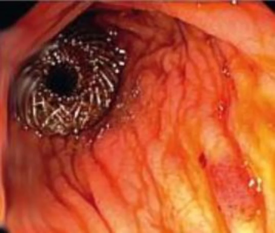 February video endoscopy