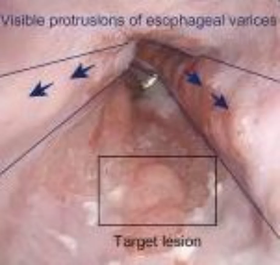 June video endoscopy