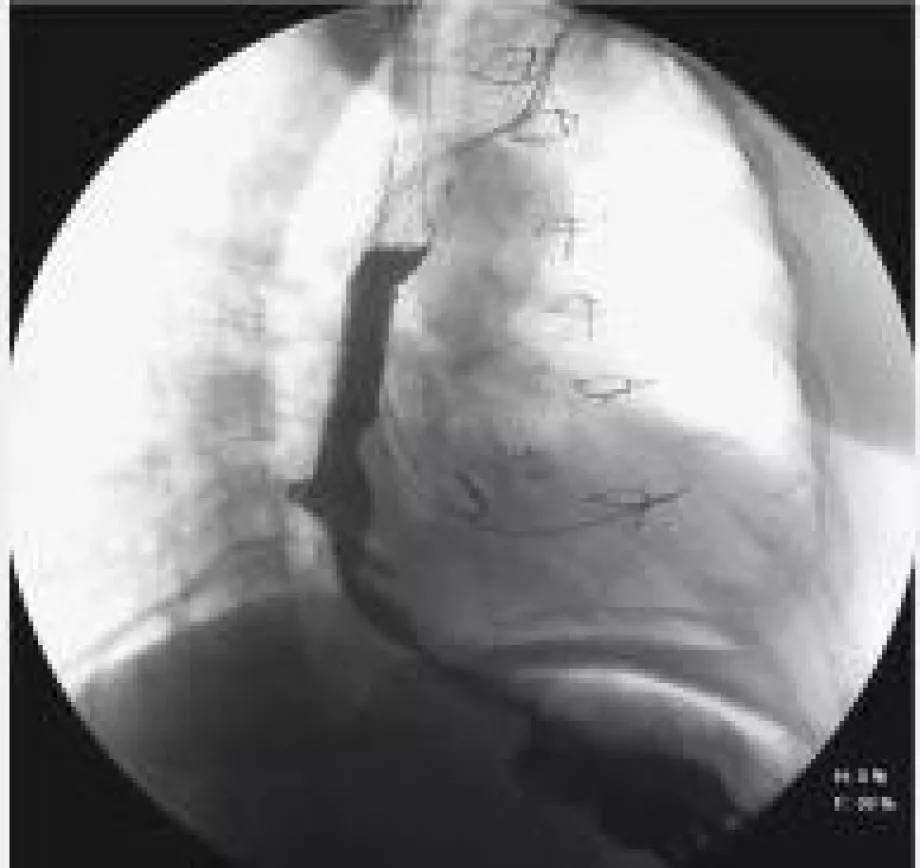 November e video corner endoscopy