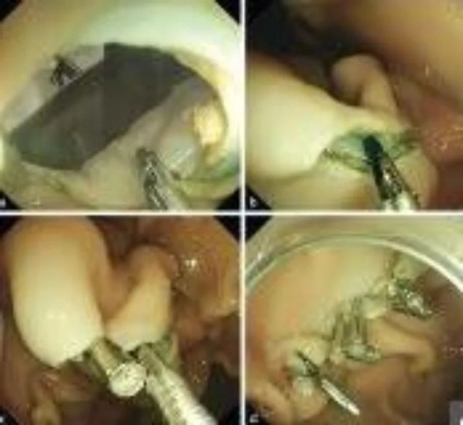 October e video corner Endoscopy