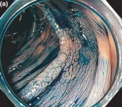 September video digestive endoscopy