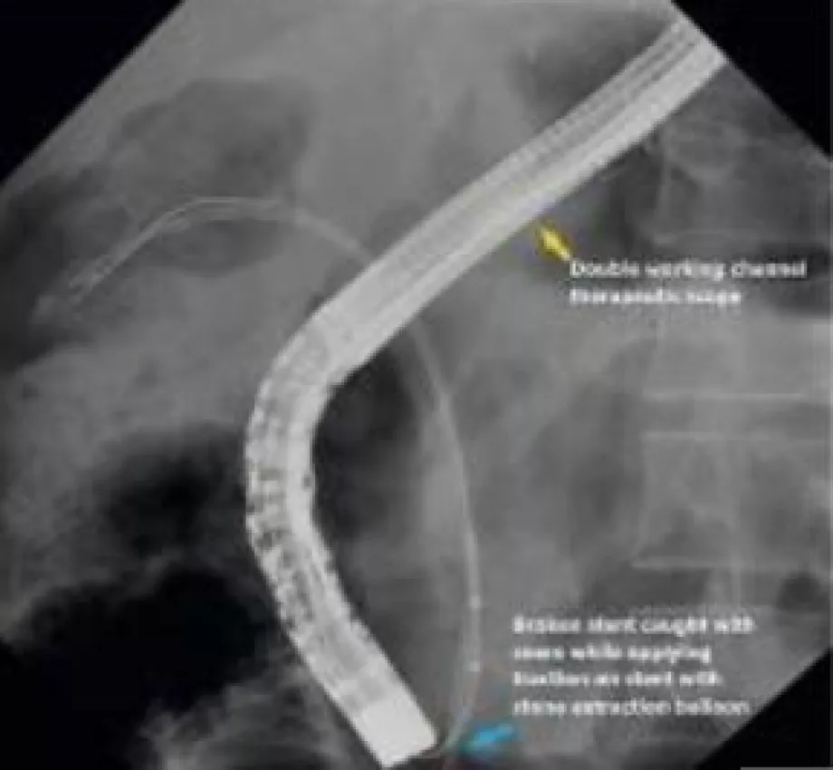 September video endoscopy