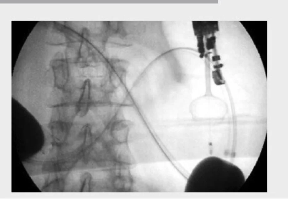 Endoscopic gastroenterostomy 3