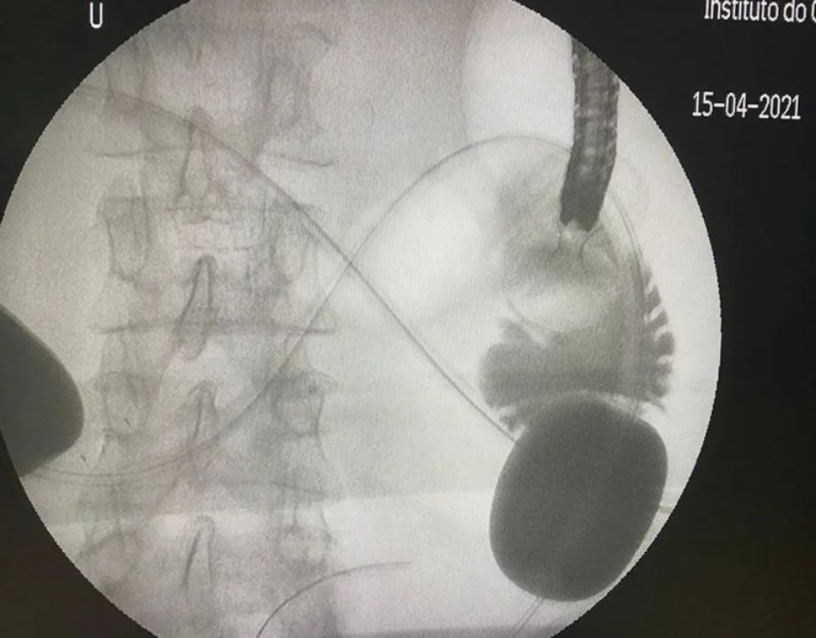 Endoscopic gastroenterostomy 4