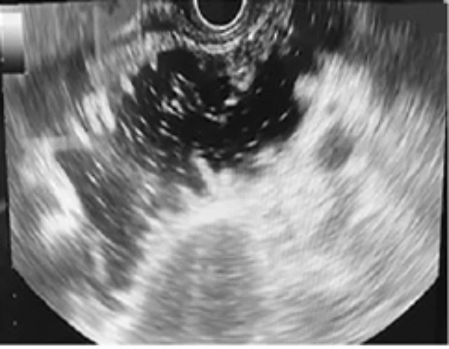 Endoscopy gastroenterostomy 1