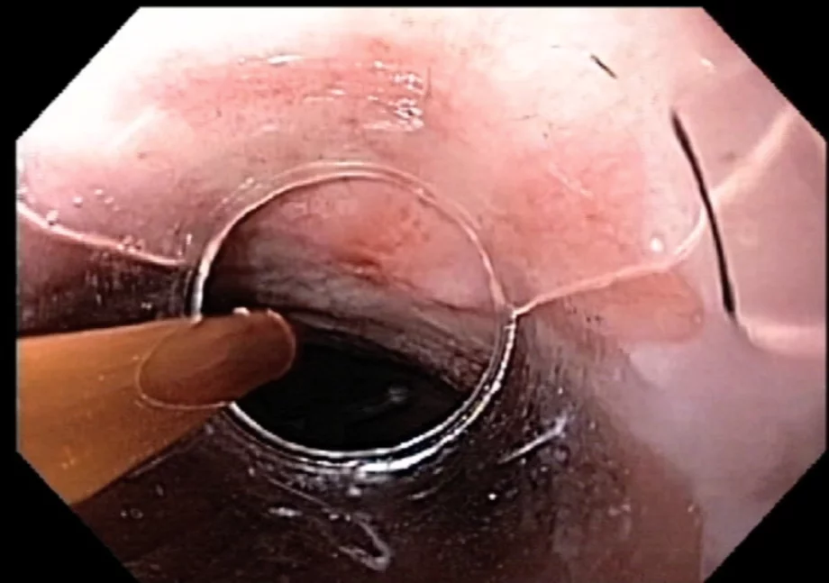 Barrett esophagus 1