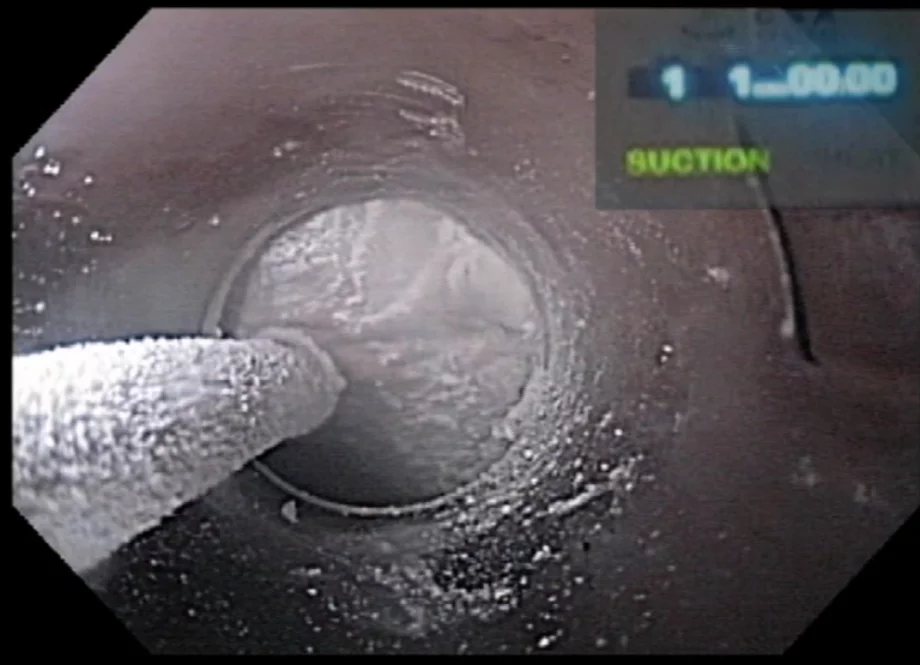 Barrett esophagus 2