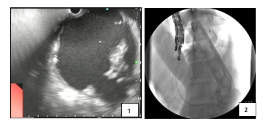Pancreatic fluid collections 1
