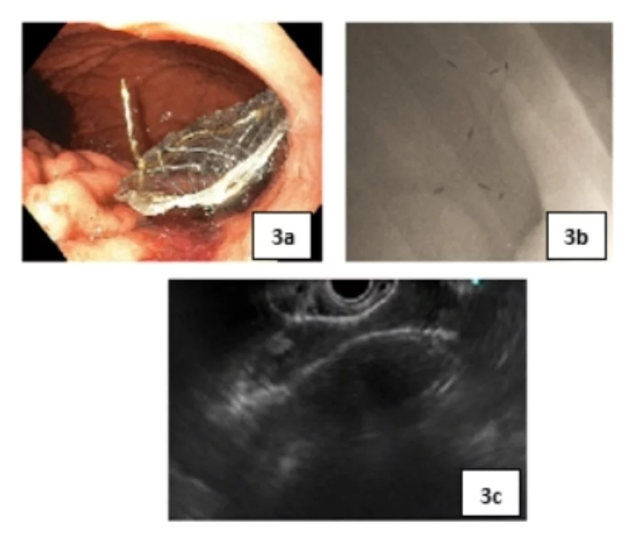 Pancreatic fluid collection 2