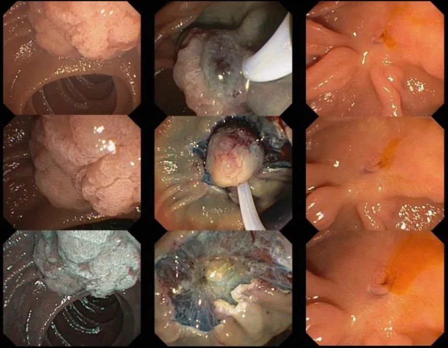 Endoscopic ampullectomy 2