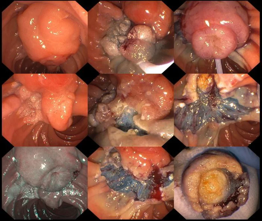 Endoscopic ampullectomy