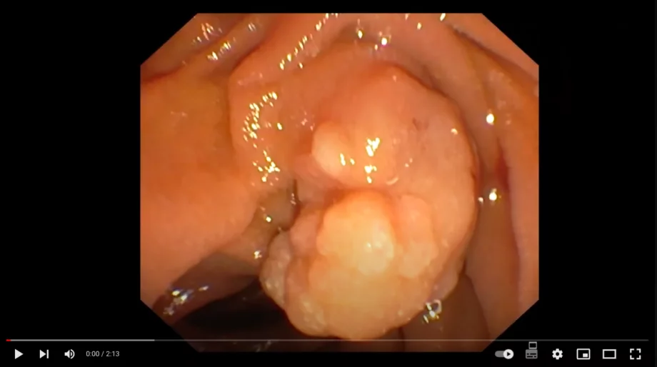 Endoscopic ampullectomy