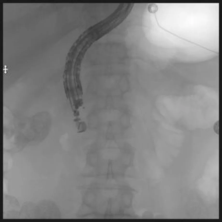 Successful eus guided 1