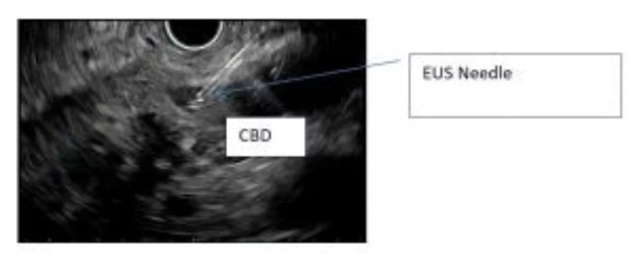 Successful eus guided 2