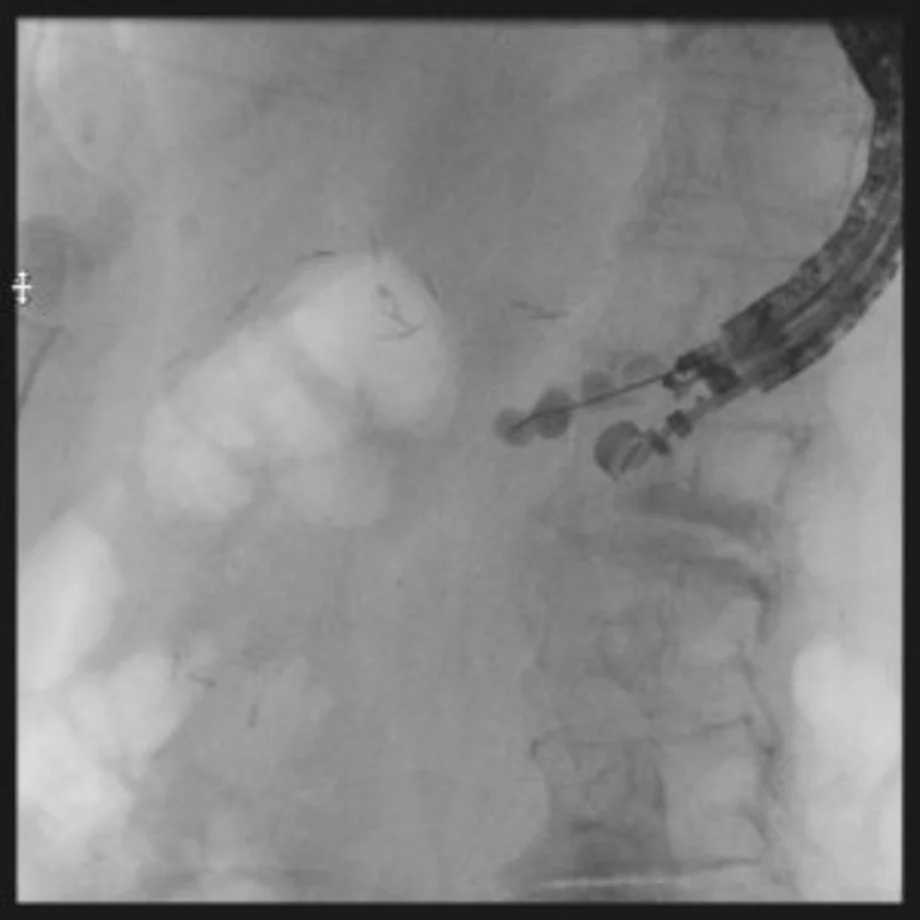 Successful eus guided 3