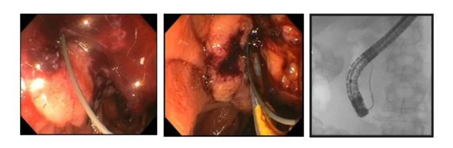 Successful eus guided 4