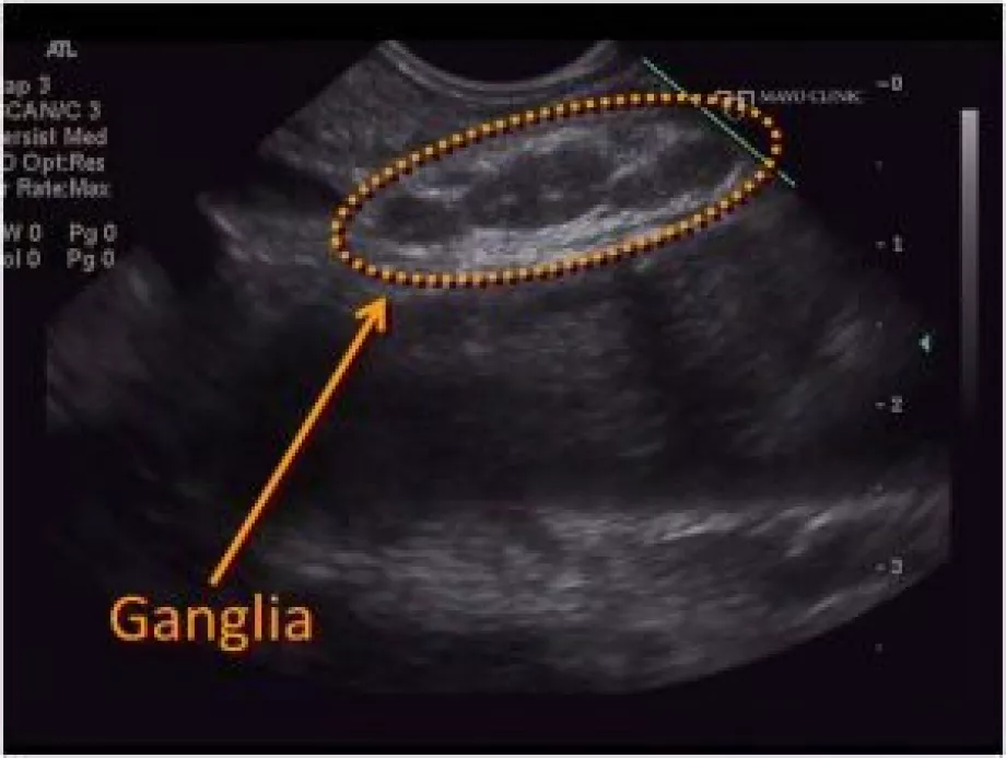 Celiac plexus
