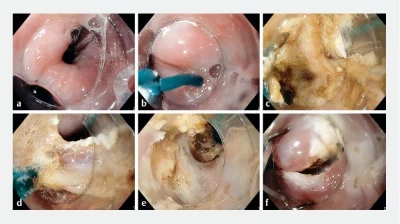 Endoscopy screen shot