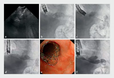 Endoscopy 1