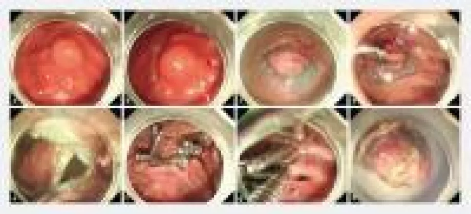 Endoscopy screen shot