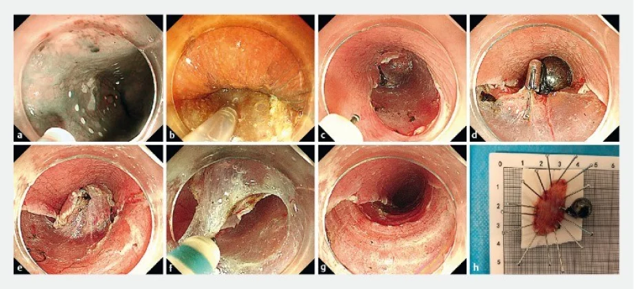 Endoscopy screen shot