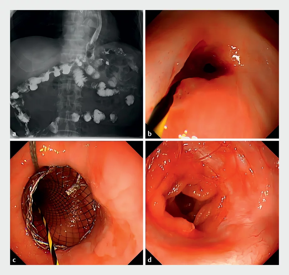Endoscopy 2