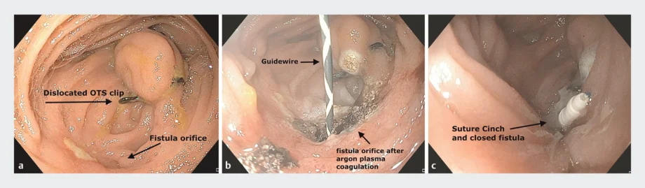 Endoscopy phtoo