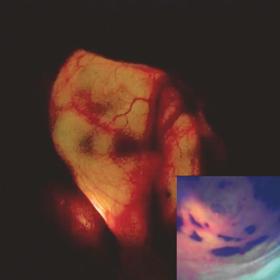 Endoscopy image sept