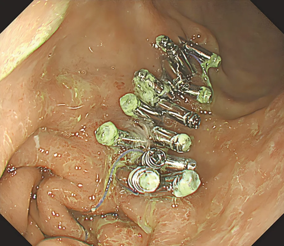 Endoscopy image