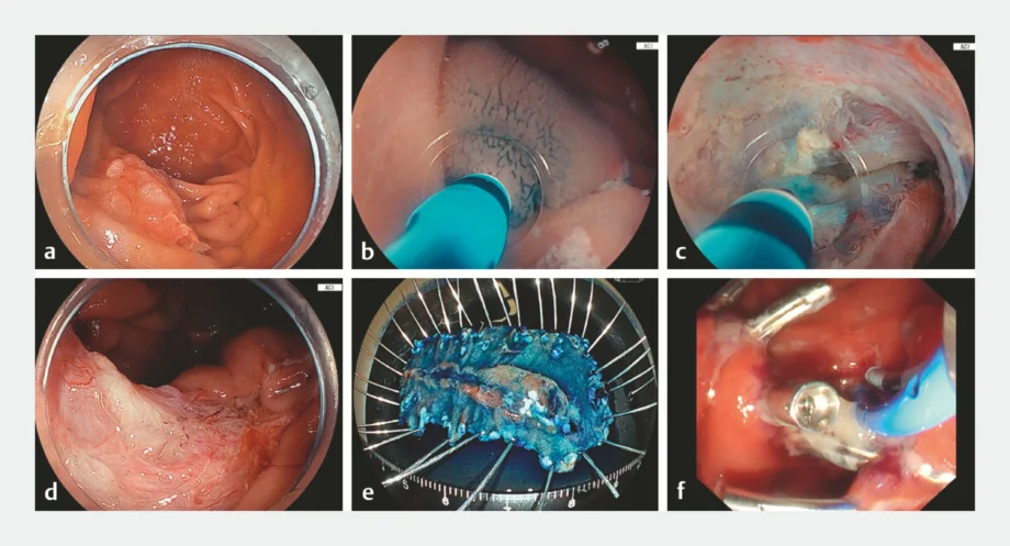 Endoscopy