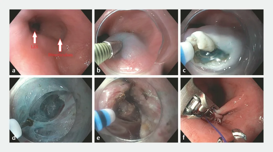 Endoscopy